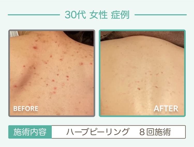 30代女性症例 ハーブピーリング 8回施術