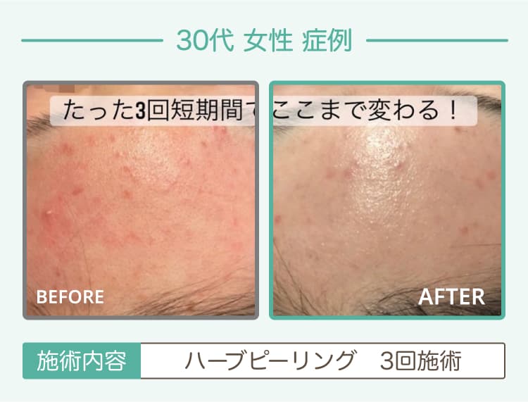 30代女性症例 ハーブピーリング 3回施術