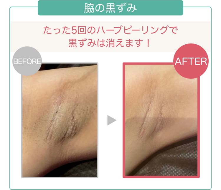 脇の黒ずみ たった5回のハーブピーリングで黒ずみは消えます!