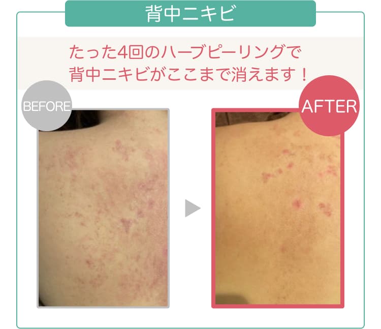 背中ニキビ たった4回のハーブピーリングで背中ニキビがここまで消えます!