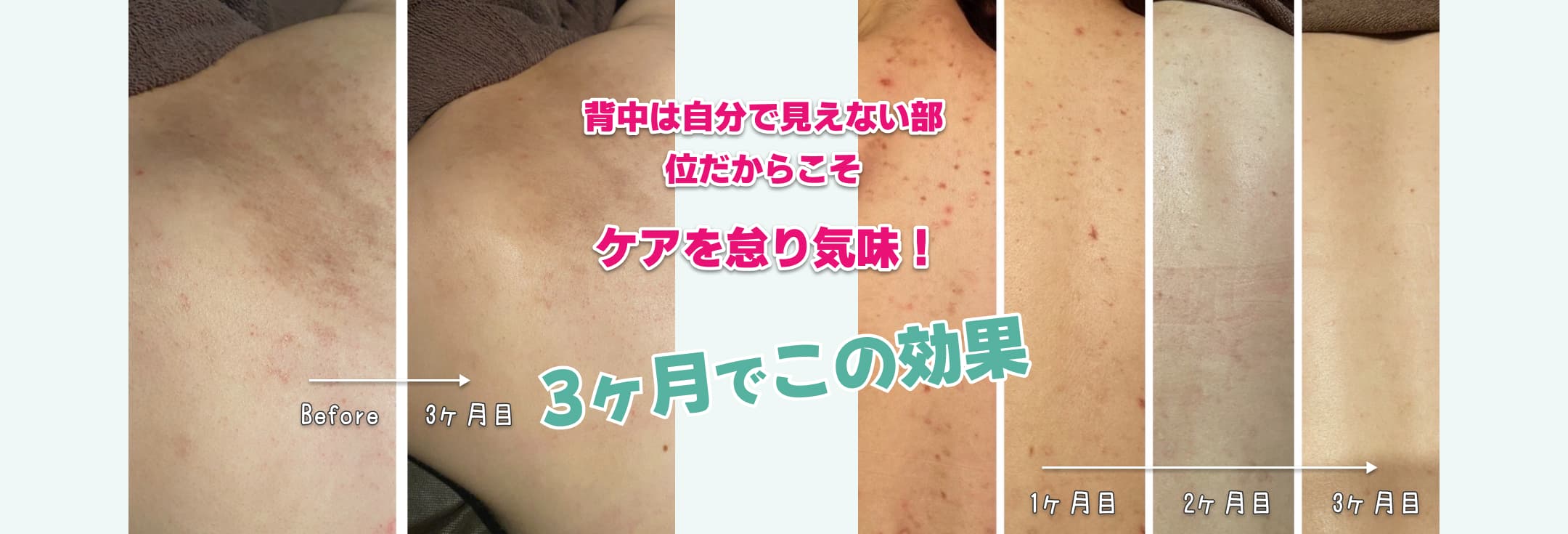 背中は自分で見せない部位だからこそケアを怠り気味!